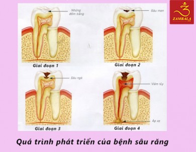 Giai đoạn phát triển của bệnh sâu răng